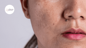 Melasma tem cura? Entenda por que o controle da pele exige estratégia e constância