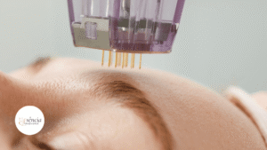 Microagulhamento: o que é, para que serve e como ele melhora a pele