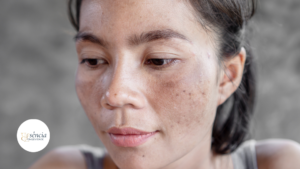 Gerenciamento de Manchas e Melasma: O Guia Definitivo Baseado na Ciência e no Autocuidado Consciente