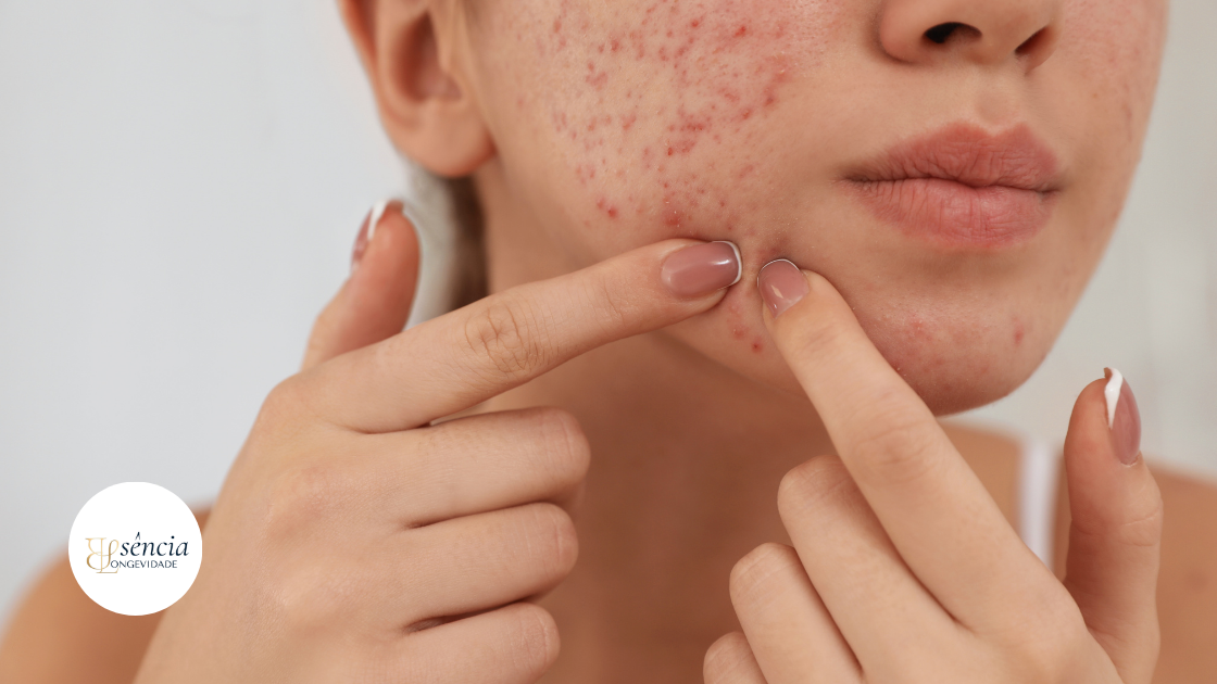Como Cuidar da Pele Acneica sem Efeito Rebote: O Guia Fisiológico Definitivo